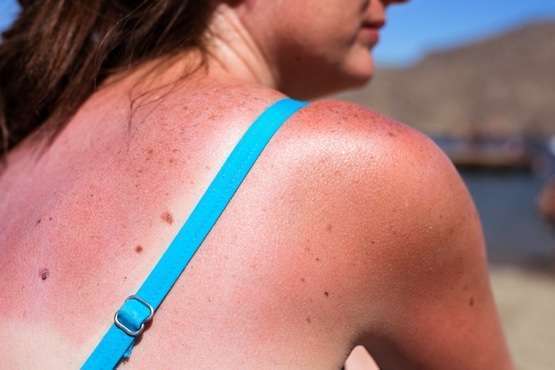 Mulher que sofre queimadura por uso equivocado de protetor solar fica sem indenização